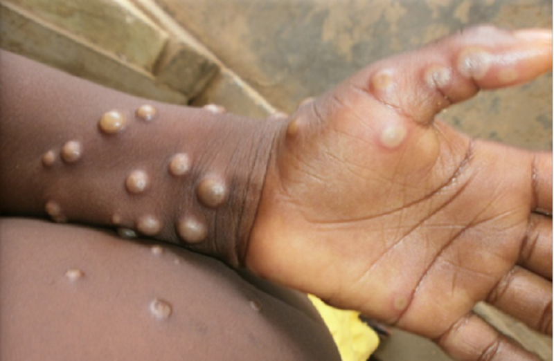 СЗО прогласи голема епидемија на мајмунски сипаници во Конго